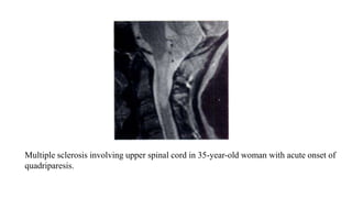 Multiple sclerosis involving upper spinal cord in 35-year-old woman with acute onset of
quadriparesis.
 