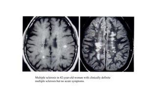 Multiple sclerosis in 42-year-old woman with clinically definite
multiple sclerosis but no acute symptoms.
 