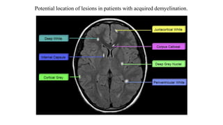 Potential location of lesions in patients with acquired demyelination.
 
