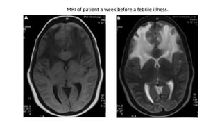 MRI of patient a week before a febrile illness.
 