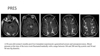 PRES
A 50-year-old woman 6 months post liver transplant experienced a generalized seizure and unresponsiveness. Blood
pressure at the time of the toxic event fluctuated markedly with a range between 106 and 200 mm Hg systolic and 54 and
80 mm Hg diastolic.
 