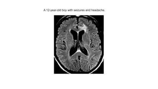 A 12-year-old boy with seizures and headache.
 