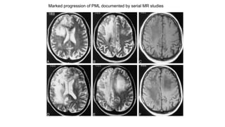 Marked progression of PML documented by serial MR studies
 