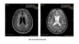 HIV ENCEPHALOPATHY
 
