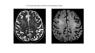 A 34-year-old male with loss of orientation to time.
 