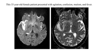 This 33 year-old female patient presented with agitation, confusion, mutism, and fever.
 
