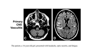 The patient, a 16-year-old girl, presented with headache, optic neuritis, and fatigue.
 