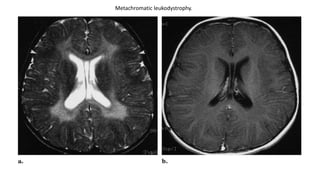 Metachromatic leukodystrophy.
 