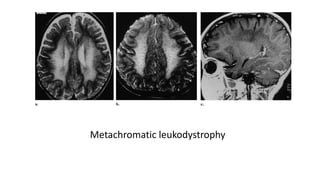 Metachromatic leukodystrophy
 