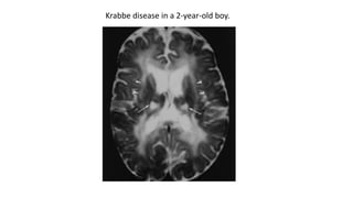 Krabbe disease in a 2-year-old boy.
 