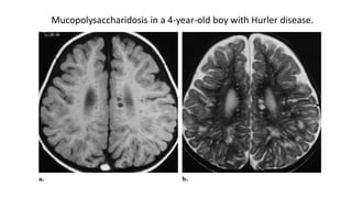 Mucopolysaccharidosis in a 4-year-old boy with Hurler disease.
 