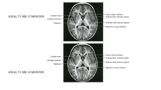 AXIAL T1 MR 12 MONTHS
AXIAL T1 MR 18 MONTHS
 