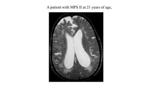 A patient with MPS II at 21 years of age,
 