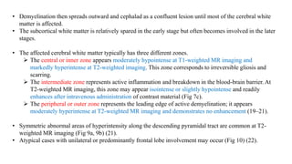 • Demyelination then spreads outward and cephalad as a confluent lesion until most of the cerebral white
matter is affected.
• The subcortical white matter is relatively spared in the early stage but often becomes involved in the later
stages.
• The affected cerebral white matter typically has three different zones.
 The central or inner zone appears moderately hypointense at T1-weighted MR imaging and
markedly hyperintense at T2-weighted imaging. This zone corresponds to irreversible gliosis and
scarring.
 The intermediate zone represents active inflammation and breakdown in the blood-brain barrier. At
T2-weighted MR imaging, this zone may appear isointense or slightly hypointense and readily
enhances after intravenous administration of contrast material (Fig 7c).
 The peripheral or outer zone represents the leading edge of active demyelination; it appears
moderately hyperintense at T2-weighted MR imaging and demonstrates no enhancement (19–21).
• Symmetric abnormal areas of hyperintensity along the descending pyramidal tract are common at T2-
weighted MR imaging (Fig 9a, 9b) (21).
• Atypical cases with unilateral or predominantly frontal lobe involvement may occur (Fig 10) (22).
 