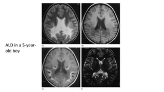ALD in a 5-year-
old boy
 