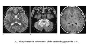 ALD with preferential involvement of the descending pyramidal tract.
 