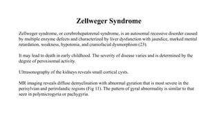 Zellweger Syndrome
Zellweger syndrome, or cerebrohepatorenal syndrome, is an autosomal recessive disorder caused
by multiple enzyme defects and characterized by liver dysfunction with jaundice, marked mental
retardation, weakness, hypotonia, and craniofacial dysmorphism (23).
It may lead to death in early childhood. The severity of disease varies and is determined by the
degree of peroxisomal activity.
Ultrasonography of the kidneys reveals small cortical cysts.
MR imaging reveals diffuse demyelination with abnormal gyration that is most severe in the
perisylvian and perirolandic regions (Fig 11). The pattern of gyral abnormality is similar to that
seen in polymicrogyria or pachygyria.
 
