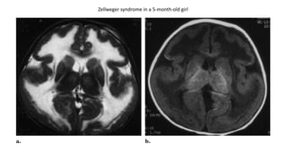 Zellweger syndrome in a 5-month-old girl
 
