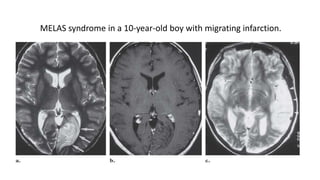 MELAS syndrome in a 10-year-old boy with migrating infarction.
 