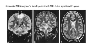 Sequential MR images of a female patient with MELAS at ages 8 and 13 years.
 