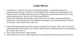 Leighs Disease
• Leigh disease, or subacute necrotizing encephalomyelopathy, is an inherited, progressive,
neurodegenerative disease of infancy or early childhood with variable course and prognosis (30).
• Affected infants and children typically present with hypotonia, psychomotor deterioration, ataxia,
ophthalmoplegia, ptosis, dystonia, and swallowing difficulties.
• Characteristic pathologic abnormalities include micro-cystic cavitation, vascular proliferation,
neuronal loss, and demyelination of the midbrain, basal ganglia, and cerebellar dentate nuclei and,
occasionally, of the cerebral white matter (31).
 Typical MR imaging findings include symmetric putaminal involvement, which may be associated
with abnormalities of the caudate nuclei, globus pallidi, thalami, and brainstem and, less frequently, of
the cerebral cortex (Fig 13).
 The cerebral white matter is rarely affected.
 Enhancement may be seen at MR imaging and may correspond to the onset of acute necrosis (31).
 