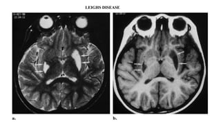 LEIGHS DISEASE
 