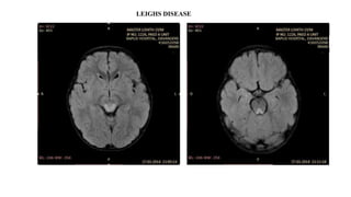LEIGHS DISEASE
 