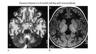 Canavan disease in a 6-month-old boy with macrocephaly
 