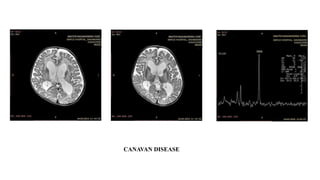 CANAVAN DISEASE
 