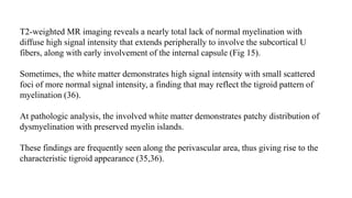 T2-weighted MR imaging reveals a nearly total lack of normal myelination with
diffuse high signal intensity that extends peripherally to involve the subcortical U
fibers, along with early involvement of the internal capsule (Fig 15).
Sometimes, the white matter demonstrates high signal intensity with small scattered
foci of more normal signal intensity, a finding that may reflect the tigroid pattern of
myelination (36).
At pathologic analysis, the involved white matter demonstrates patchy distribution of
dysmyelination with preserved myelin islands.
These findings are frequently seen along the perivascular area, thus giving rise to the
characteristic tigroid appearance (35,36).
 