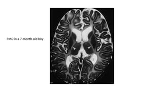 PMD in a 7-month-old boy
 