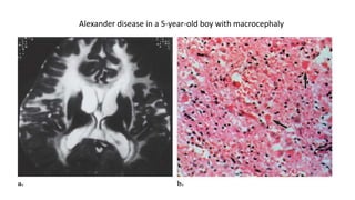 Alexander disease in a 5-year-old boy with macrocephaly
 