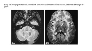 Early MR imaging studies in a patient with presumed juvenile Alexander disease, obtained at the age of 4
years.
 