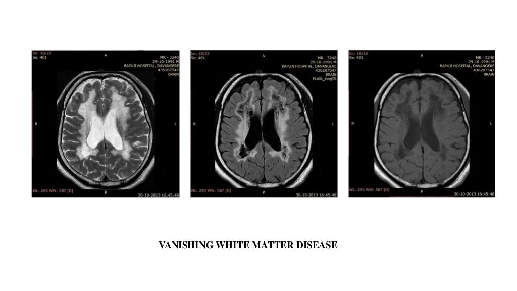 Mri in white matter diseases