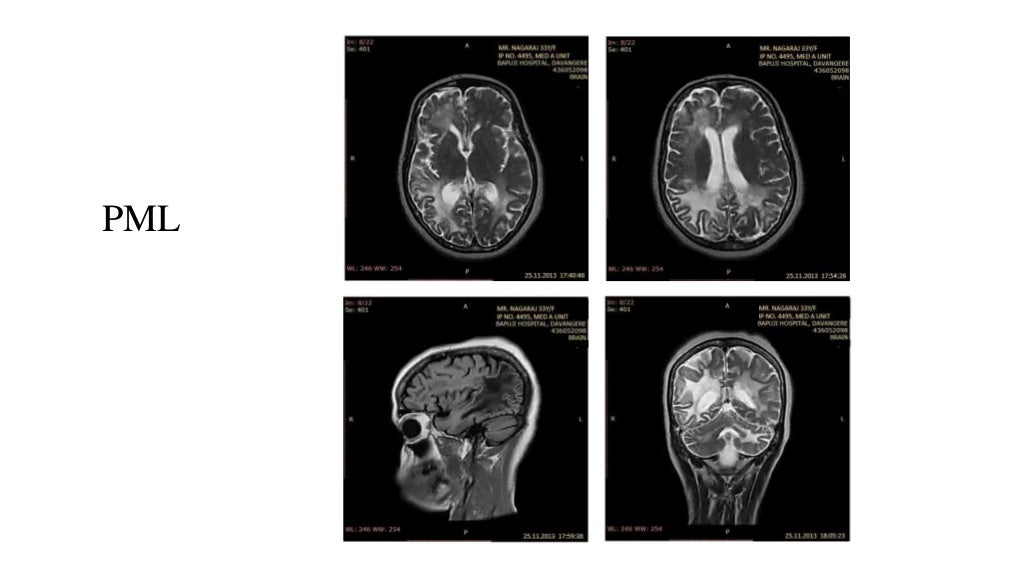 Mri in white matter diseases