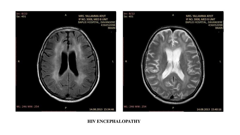 Mri in white matter diseases