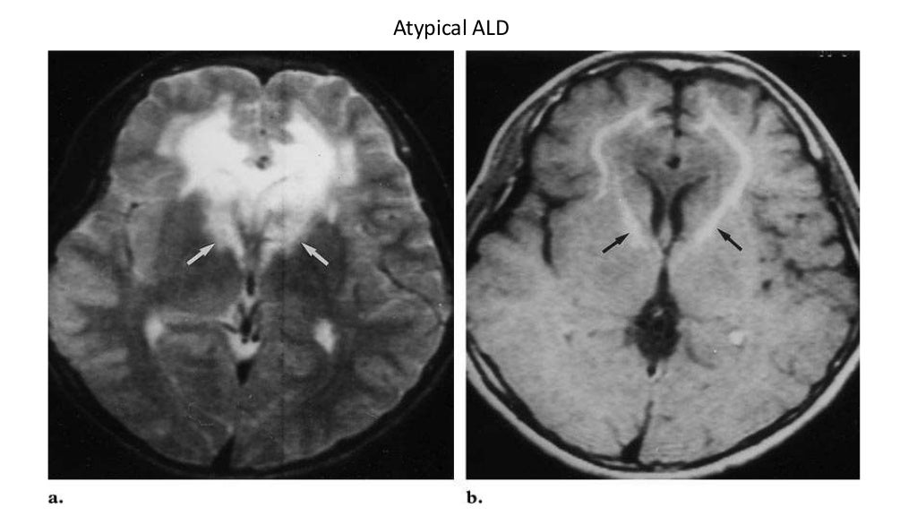 Mri in white matter diseases