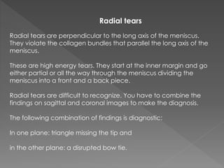 Triangle Tear Mri knee trauma | PPTX