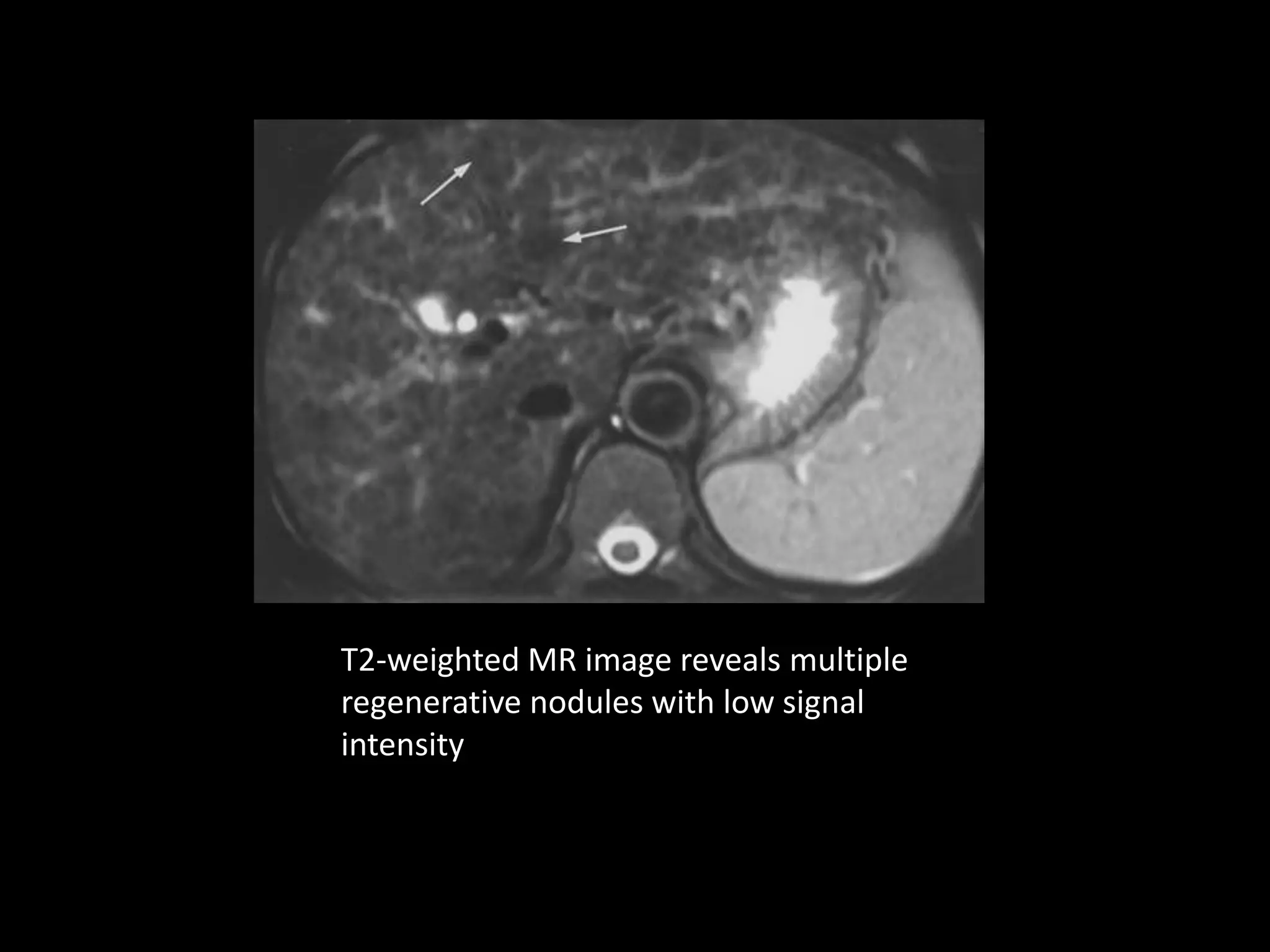MR imaging of liver | PPTX | Endocrine and Metabolic Diseases ...