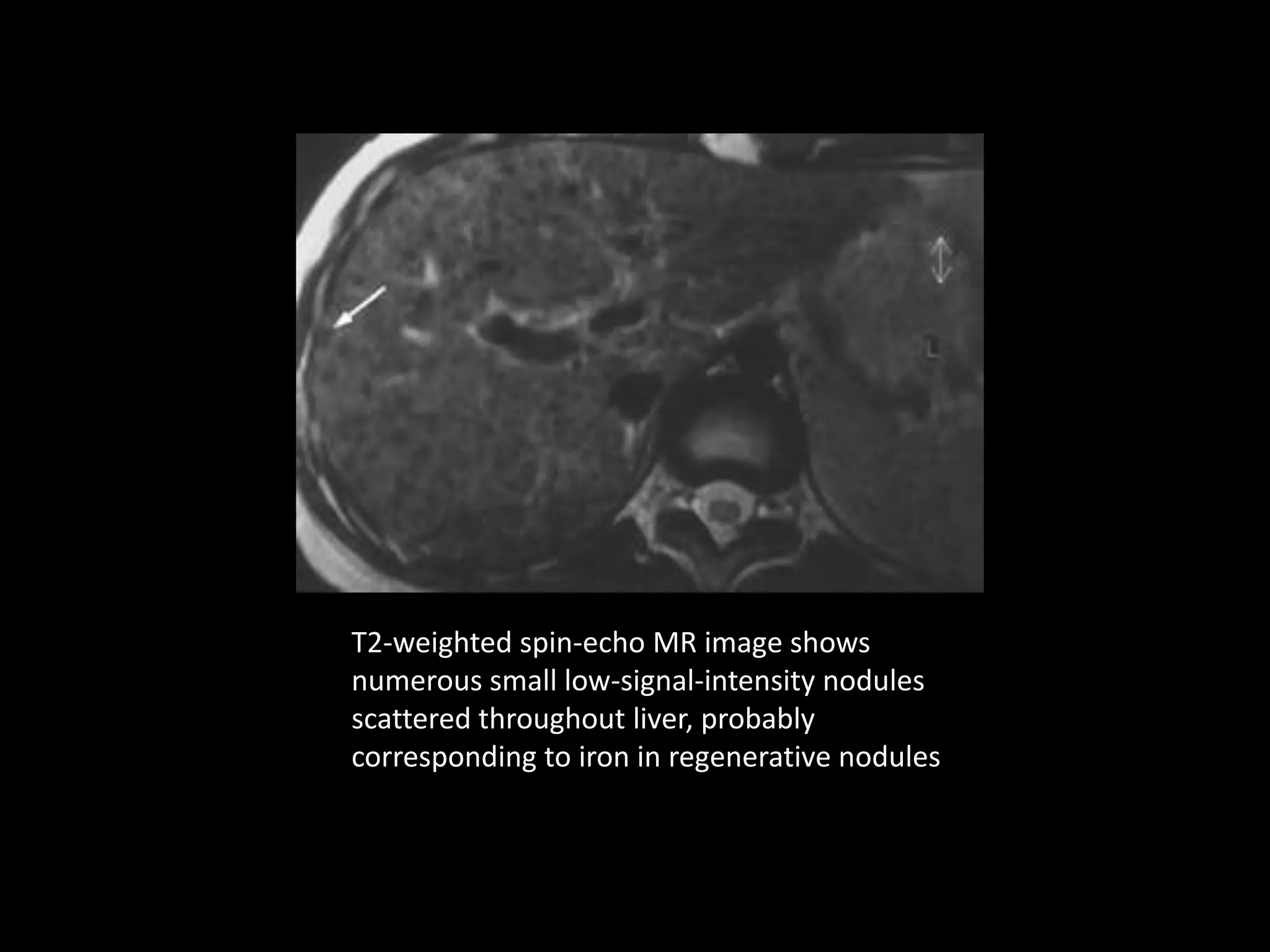 MR imaging of liver | PPTX | Endocrine and Metabolic Diseases ...