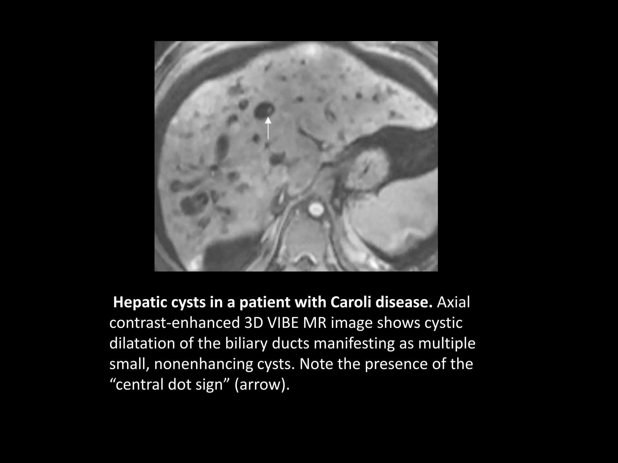 MR imaging of liver | PPTX | Endocrine and Metabolic Diseases ...