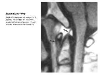 Normal anatomy
Sagittal T1-weighted MR image (TR/TE,
510/25) obtained on 0.3-T scanner
shows normal apical ligament (1) and
anterior atlantoaxial membrane (2).
 