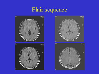 Mr imaging of brain | PPT