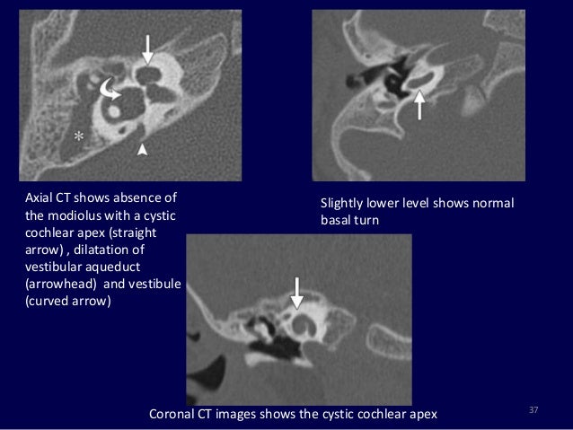 Magnetic Resonance Imaging Of Inner Ear