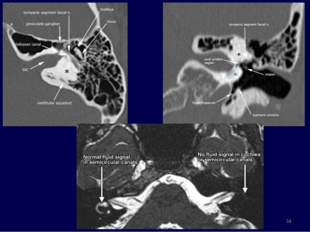 Magnetic Resonance Imaging Of Inner Ear