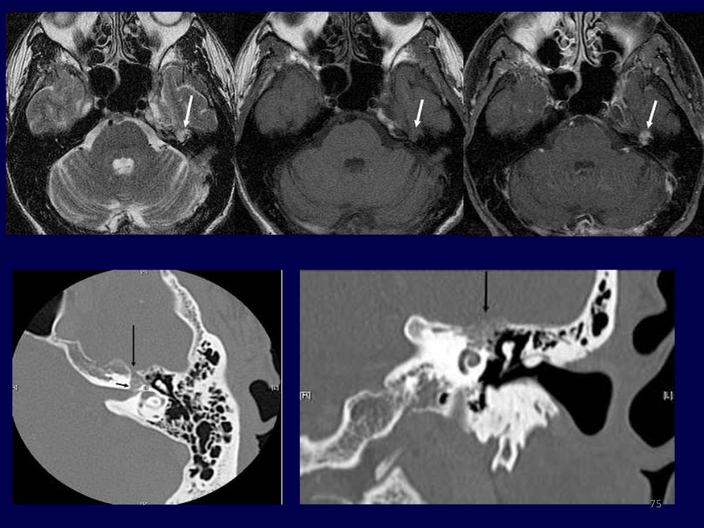 Resonance Imaging Of Inner Ear
