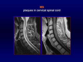 Mr imaging of spine