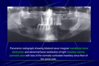 Rarefaction Radiograph MRI magnetic resonance in head and neck | PPT