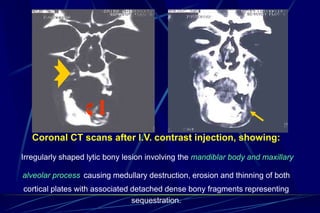 Coronal Process On Radiograph MRI magnetic resonance in head and neck | PPT
