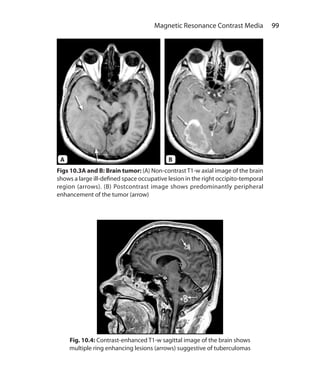 99 Magnetic Resonance Contrast Media
Fig. 10.4: Contrast-enhanced T1-w sagittal image of the brain shows
multiple ring enhancing lesions (arrows) suggestive of tuberculomas
Figs 10.3A and B: Brain tumor: (A) Non-contrast T1-w axial image of the brain
shows a large ill-defined space occupative lesion in the right occipito-temporal
region (arrows). (B) Postcontrast image shows predominantly peripheral
enhancement of the tumor (arrow)
A B
Ch-10.indd 99 13-09-2012 16:05:49
 